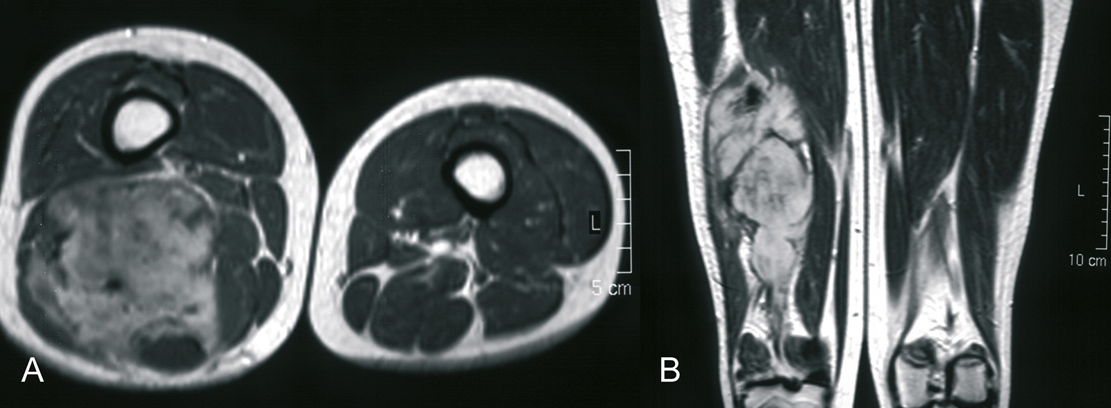 Abb. 8-56: Aggressive Fibromatose im Bereich des dorsalen Oberschenkels (Eigentum des Instituts für Klinische Radiologie der Universität Münster)
