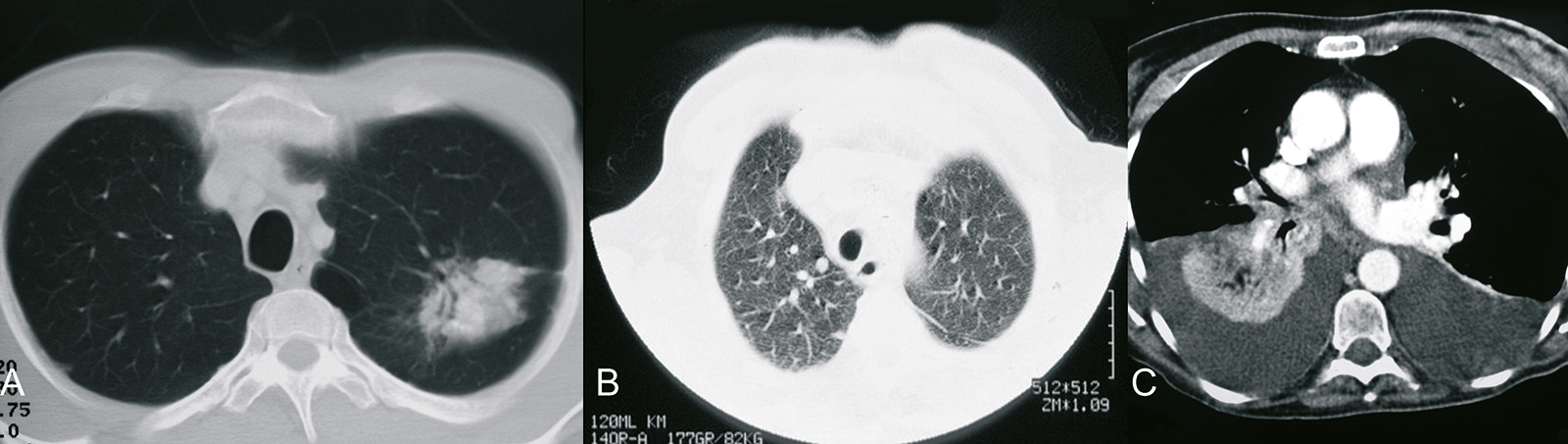 Abb. 8-58: Einzelne Metastase im rechten Unterlappen (A), multiple kleine Lungenmetastasen (B) und ausgedehnte Metastase mit sekundärem Pleuraerguss (C) (Eigentum des Instituts für Klinische Radiologie der Universität Münster)