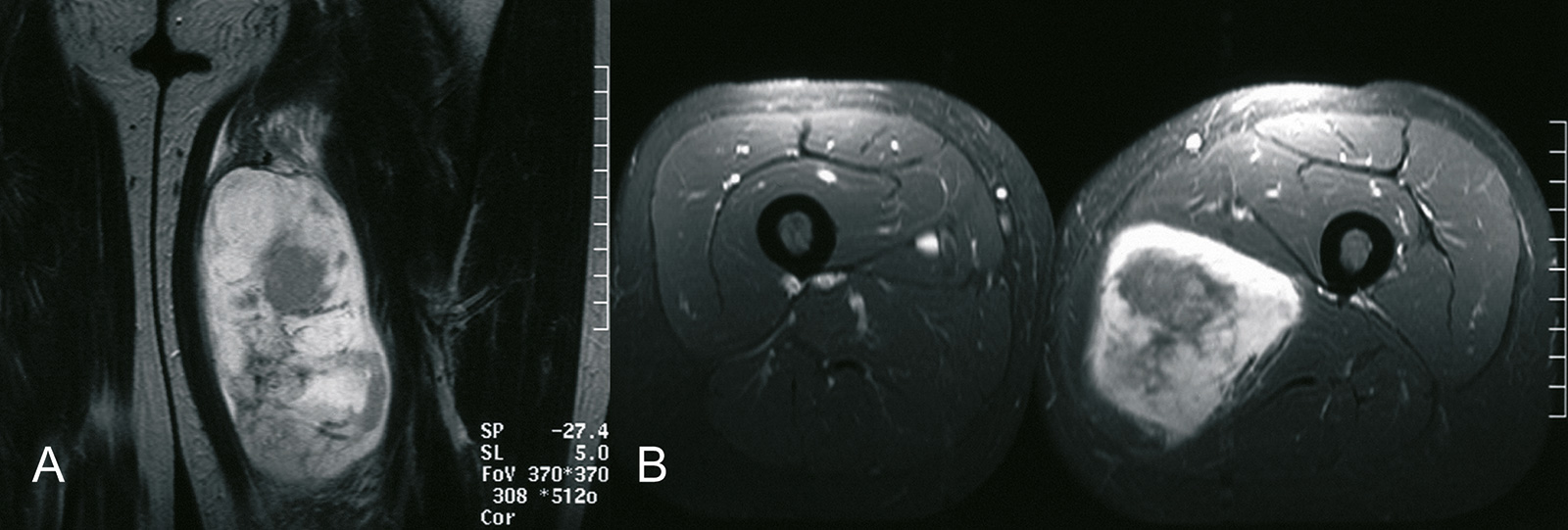 Abb. 8-59: Ausgedehntes Weichteilsarkom in der Adduktorenloge: MRT-Bildgebung (A,B) (Eigentum des Instituts für Klinische Radiologie der Universität Münster)