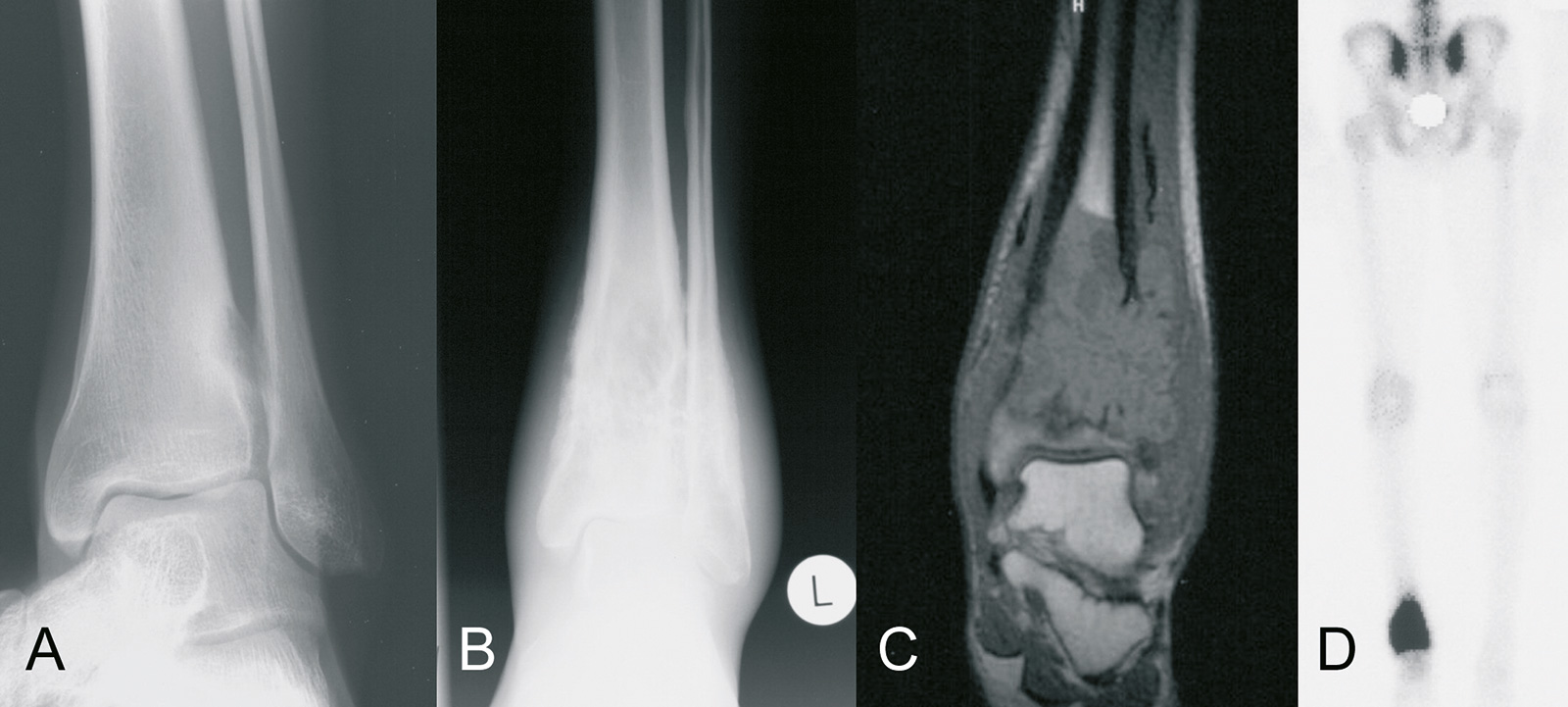 Abb. 8-72: Osteosarkom der distalen Tibia. Auf der initialen Röntgenaufnahme (A) wurde der Tumor wegen der nur geringen Veränderung nicht diagnostiziert, 4 Monate später zeigt sich ein ausgedehntes Osteosarkom: natives Röntgenbild (B), MRT-Bildgebung (C) 