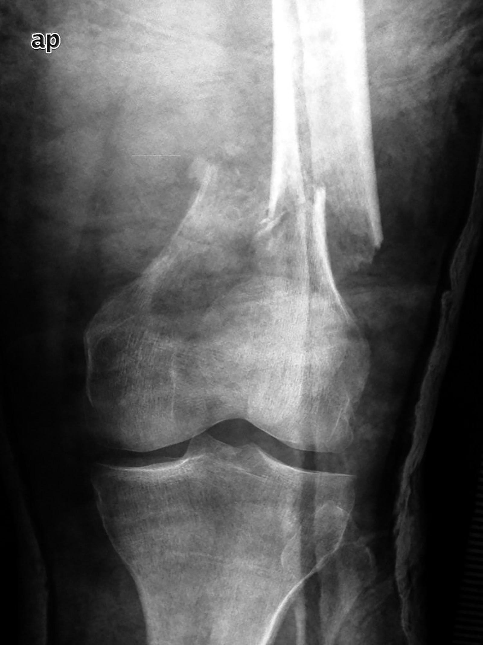 Abb. 8-77: Pathologische Fraktur bei einem Patienten mit einem Plasmozytom und Befall des distalen Femurs (Eigentum des Insituts für Klinische Radiologie der Universität Münster)