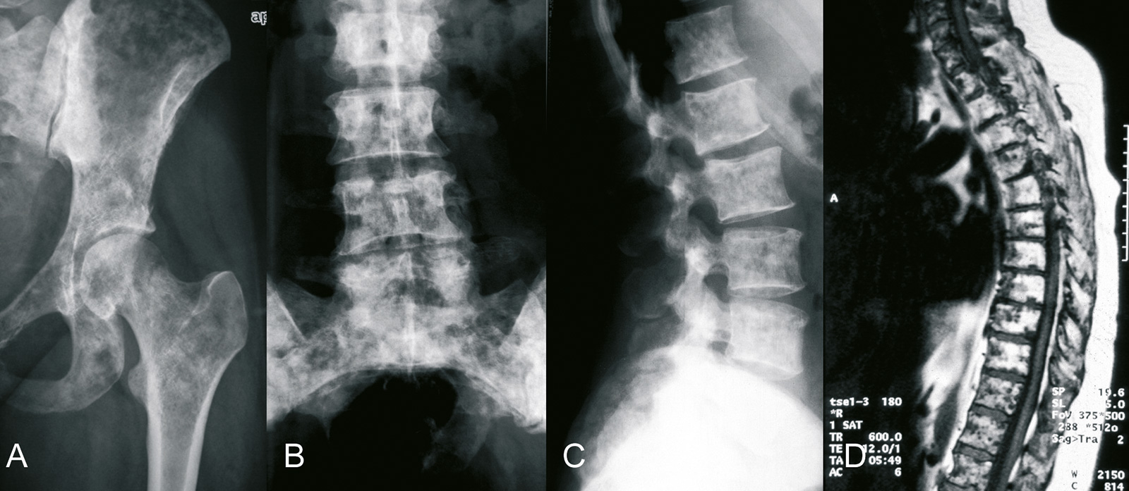 Abb. 8-80: Multiple osteoblastische Metastasen bei einem Patienten mit einem Mamma-Ca: native Röntgen- (A-C) und MRT-Bildgebung (D) (Eigentum des Instituts für Klinische Radiologie der Universität Münster)