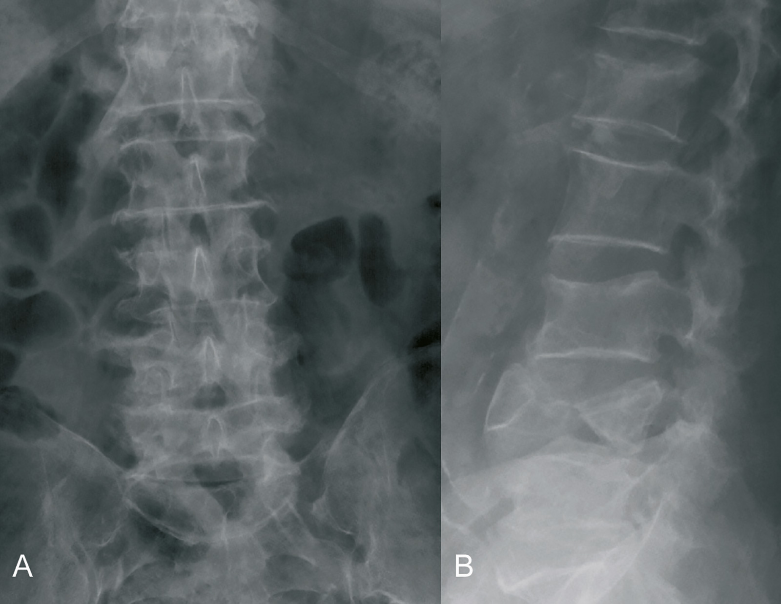 Abb. 9-1: Fischwirbel LWK4 bei einer 73 jährigen Patientin mit Osteoporose