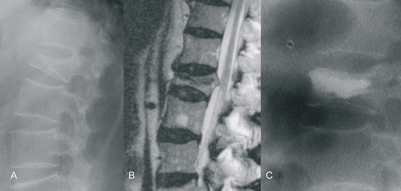 Abb. 9-4: Patient mit einem Keilwirbel LWK 2 und starken Schmerzen (A-B), nach Durchführung einer Kyphoplastik (C) (Eigentum des Instituts für Klinische Radiologie der Universität Münster)